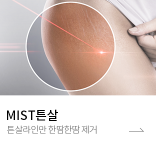 튼살